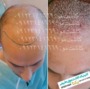 فیلم کاشت به روش fut در کلینیک یکتا