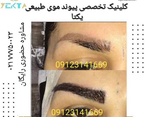کاشت مو طبیعی یکتا ۲ کاشت مو طبیعی یکتا ۲