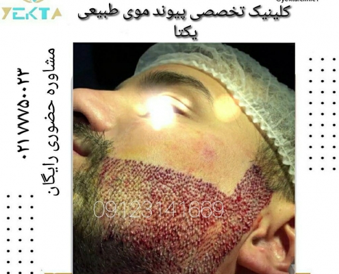 کاشت مو طبیعی یکتا ۱ کاشت مو طبیعی یکتا ۱