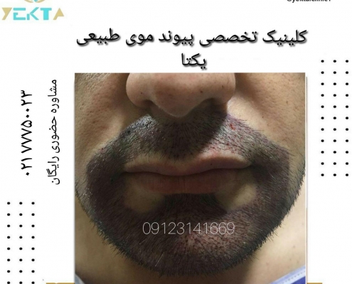 کاشت مو طبیعی یکتا کاشت مو طبیعی یکتا