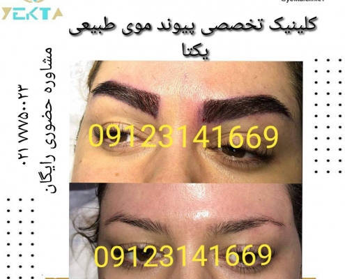 کاشت مو طبیعی یکتا ۳ کاشت مو طبیعی یکتا ۳