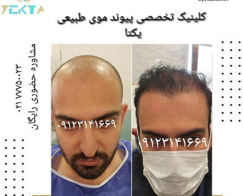 کاشت مو طبیعی یکتا ۴ کاشت مو طبیعی یکتا ۴