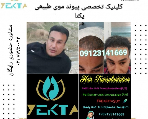 کاشت مو طبیعی یکتا ۵ کاشت مو طبیعی یکتا ۵