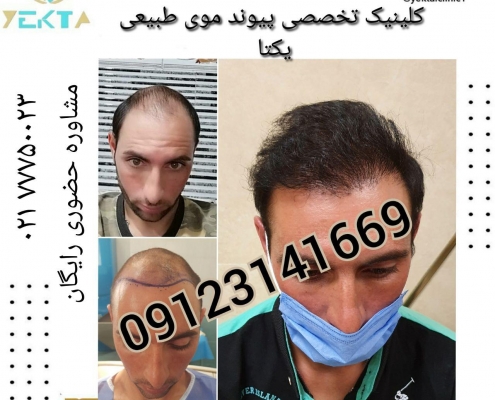 کاشت مو طبیعی یکتا ۶ کاشت مو طبیعی یکتا ۶