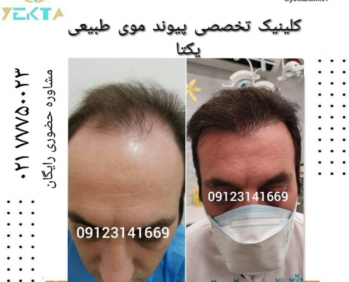 کاشت مو طبیعی یکتا ۷ کاشت مو طبیعی یکتا ۷