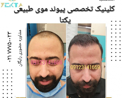 کاشت مو طبیعی یکتا ۸ کاشت مو طبیعی یکتا ۸